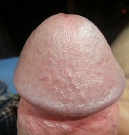 Foto der vergrößerten Eichel des Penis