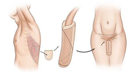 Muskeltransplantation zur Penisvergrößerung