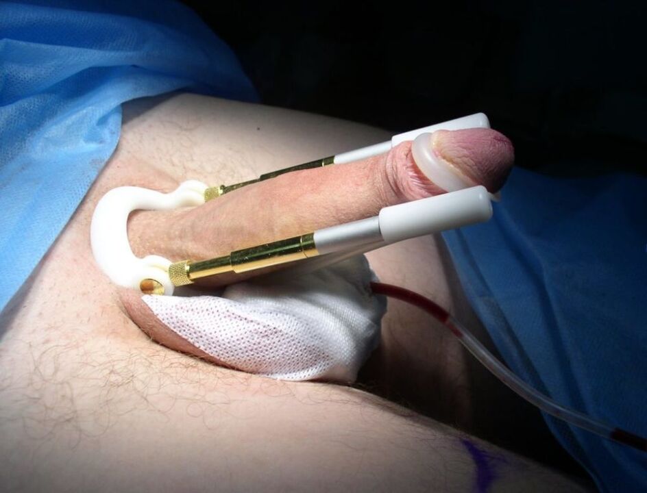 Extender nach einer Penisvergrößerungsoperation