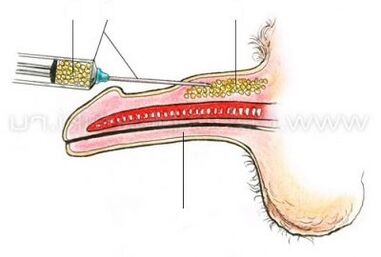 Penisvergrößerung durch Injektion