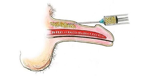 Muskelgewebetransplantation zur Vergrößerung des Penis.