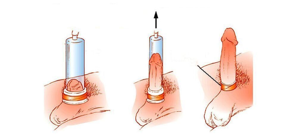 Wie funktioniert eine Penis-Vakuumpumpe